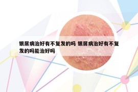 银屑病治好有不复发的吗 银屑病治好有不复发的吗能治好吗