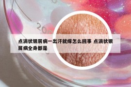 点滴状银屑病一出汗就痒怎么回事 点滴状银屑病全身都是