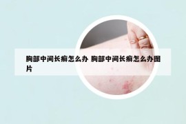 胸部中间长癣怎么办 胸部中间长癣怎么办图片