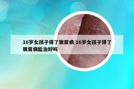 16岁女孩子得了银屑病 16岁女孩子得了银屑病能治好吗