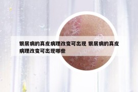 银屑病的真皮病理改变可出现 银屑病的真皮病理改变可出现哪些