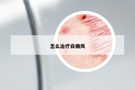 怎么冶疗白癜风