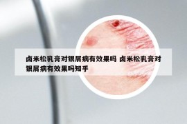 卤米松乳膏对银屑病有效果吗 卤米松乳膏对银屑病有效果吗知乎