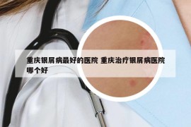 重庆银屑病最好的医院 重庆治疗银屑病医院哪个好