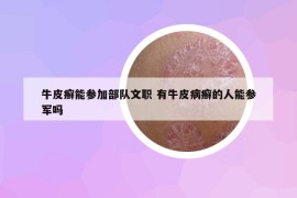 牛皮癣能参加部队文职 有牛皮病癣的人能参军吗