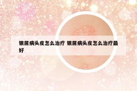 银屑病头皮怎么治疗 银屑病头皮怎么治疗最好