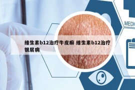 维生素b12治疗牛皮癣 维生素b12治疗银屑病