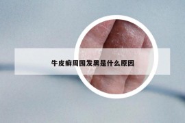 牛皮癣周围发黑是什么原因