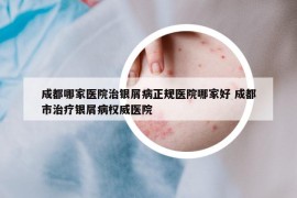 成都哪家医院治银屑病正规医院哪家好 成都市治疗银屑病权威医院