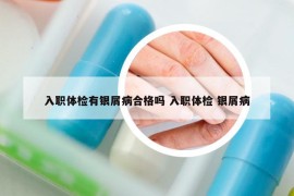 入职体检有银屑病合格吗 入职体检 银屑病