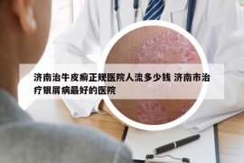 济南治牛皮癣正规医院人流多少钱 济南市治疗银屑病最好的医院