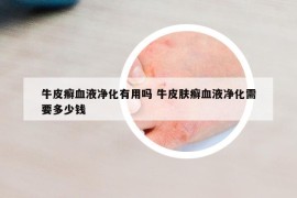 牛皮癣血液净化有用吗 牛皮肤癣血液净化需要多少钱