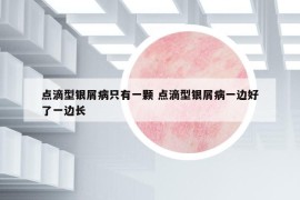 点滴型银屑病只有一颗 点滴型银屑病一边好了一边长