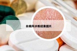 白癜风诊断结果图片