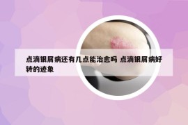 点滴银屑病还有几点能治愈吗 点滴银屑病好转的迹象