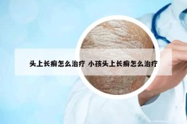 头上长癣怎么治疗 小孩头上长癣怎么治疗