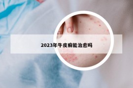 2023年牛皮癣能治愈吗