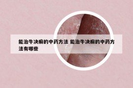 能治牛决癣的中药方法 能治牛决癣的中药方法有哪些