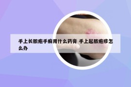 手上长脓疱手癣用什么药膏 手上起脓疱疹怎么办