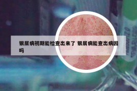 银屑病初期能检查出来了 银屑病能查出病因吗