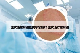 重庆治银屑病医院哪家最好 重庆治疗银屑病