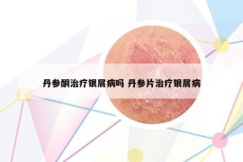 丹参酮治疗银屑病吗 丹参片治疗银屑病