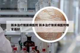 新乡治疗银屑病医院 新乡治疗银屑病医院哪家最好