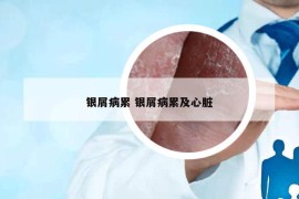 银屑病累 银屑病累及心脏