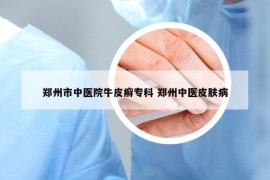 郑州市中医院牛皮癣专科 郑州中医皮肤病