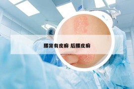 腰背有皮癣 后腰皮癣