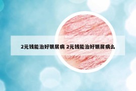 2元钱能治好银屑病 2元钱能治好银屑病么