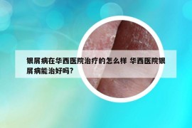 银屑病在华西医院治疗的怎么样 华西医院银屑病能治好吗?