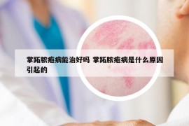 掌跖脓疱病能治好吗 掌跖脓疱病是什么原因引起的