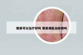 银屑可以治疗好吗 银屑病能治除根吗