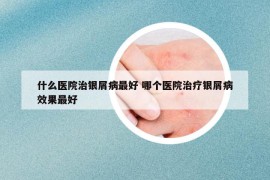 什么医院治银屑病最好 哪个医院治疗银屑病效果最好