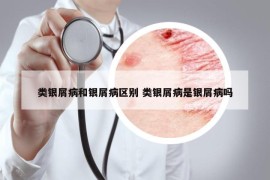 类银屑病和银屑病区别 类银屑病是银屑病吗