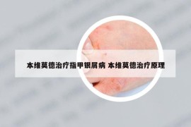 本维莫德治疗指甲银屑病 本维莫德治疗原理