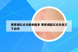 银屑病红点点越串越多 银屑病起红点会自己下去吗