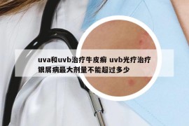 uva和uvb治疗牛皮癣 uvb光疗治疗银屑病最大剂量不能超过多少