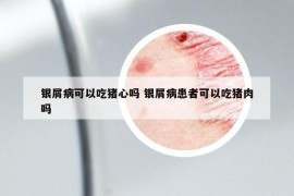 银屑病可以吃猪心吗 银屑病患者可以吃猪肉吗