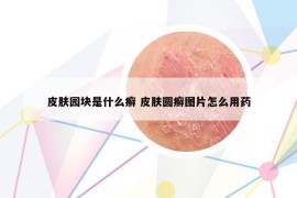 皮肤园块是什么癣 皮肤圆癣图片怎么用药