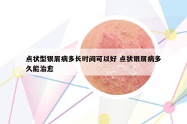 点状型银屑病多长时间可以好 点状银屑病多久能治愈