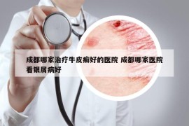 成都哪家治疗牛皮癣好的医院 成都哪家医院看银屑病好