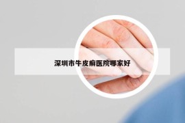 深圳市牛皮癣医院哪家好