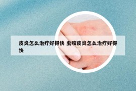 皮炎怎么治疗好得快 虫咬皮炎怎么治疗好得快