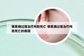 银屑病过度治疗所致死亡 银屑病过度治疗所致死亡的原因