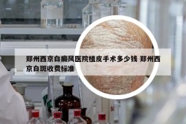 郑州西京白癜风医院植皮手术多少钱 郑州西京白斑收费标准