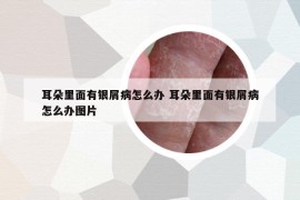 耳朵里面有银屑病怎么办 耳朵里面有银屑病怎么办图片