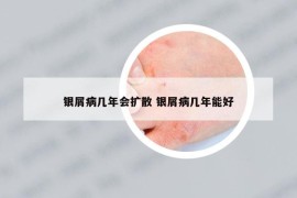 银屑病几年会扩散 银屑病几年能好