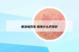 癣涂啥药膏 癣用什么药膏好